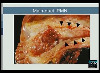 Characterization and Differential Diagnosis of Cystic Pancreatic Lesions: Fine-Needle Aspiration