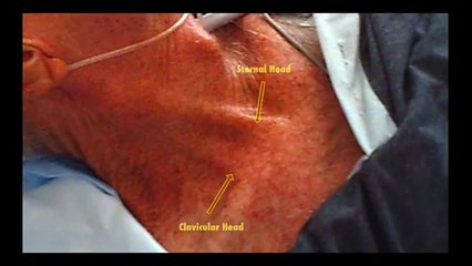 Internal jugular central line insertion