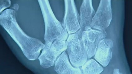 علاج جديد لمرض التهاب المفاصل الروماتزمي