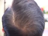 Hair transplant closeup 6 crown