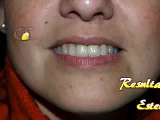 Coronas y fundas dentales de circonio