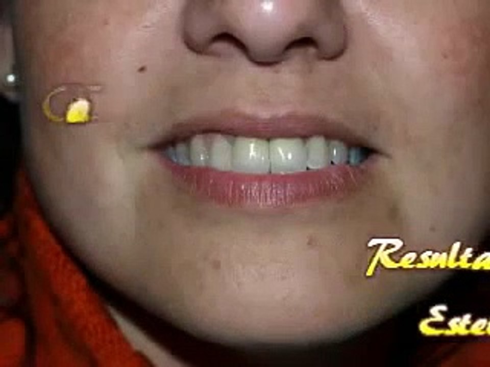 Coronas y fundas dentales de circonio