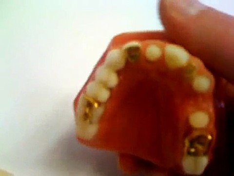 Couronne dentaire céramique, prothèses dentaires ( les-dents.com).mov