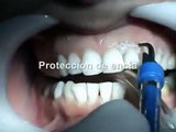 Blanqueamiento dental, caso clínico con lampara de leds