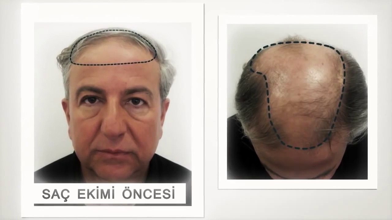 Saç Ekimi Öncesi Sonrası - Mehmet Şafak Anılmış