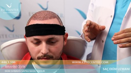 İbrahim Çevik Anlatıyor "Saç Ekimi Sonrasında Şapka Nasıl Takılmalıdır?"