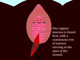 Episiotomy  Repair: Animation of the closure procedure