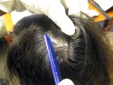 Examining Clear-Cut Robot Hair Transplant Systems
