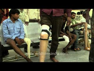 Patient fitting an artificial limb, Jaipur