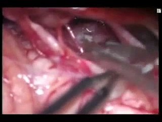 Worm Brain Tumor