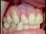 Inflammation in Gums Bacteria is Earliest Stage of Gingivitis & Gum Disease