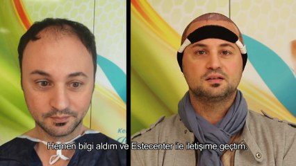 Saç Ektiren Hasta Yorumları - Enrique Sanchez