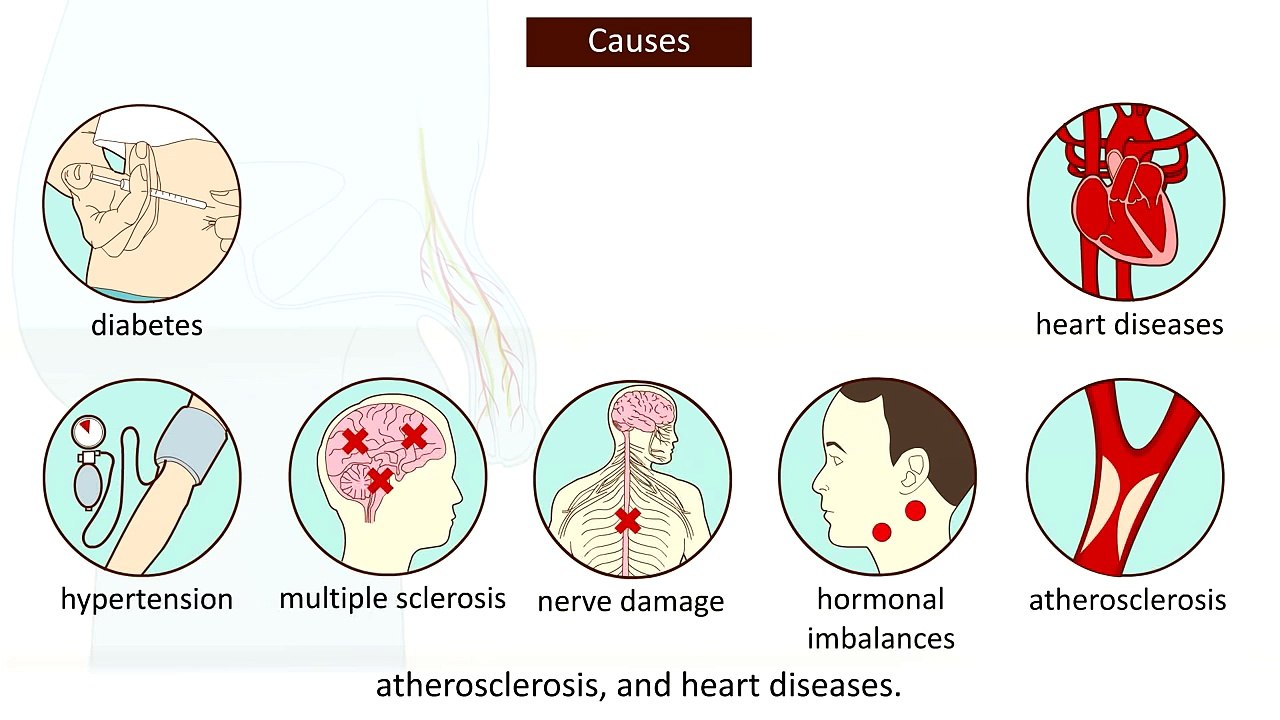 Erectile Dysfunction (ED) - Causes, symptoms and treatment modalities