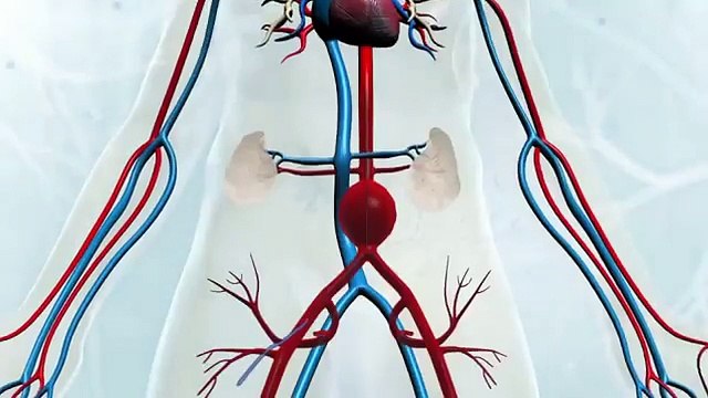 Cirurgia Endovascular de Aneurisma da Aorta Abdominal