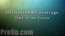 Dilation and Curettage D & C Surgery PreOp® Patient Engagement and Education