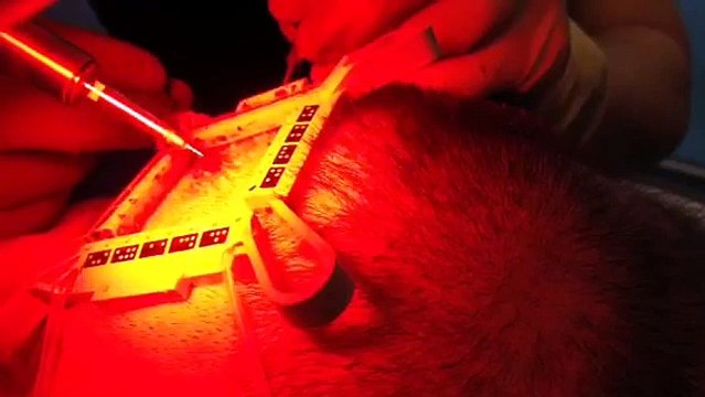 Opération de prélèvement d'implants capillaires The Clinic Paris & robot ARTAS