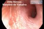 Otite Média Serosa- Videotosocopia com Manobra de Valsalva\ Otoendoscopy in Serous Otitis Media