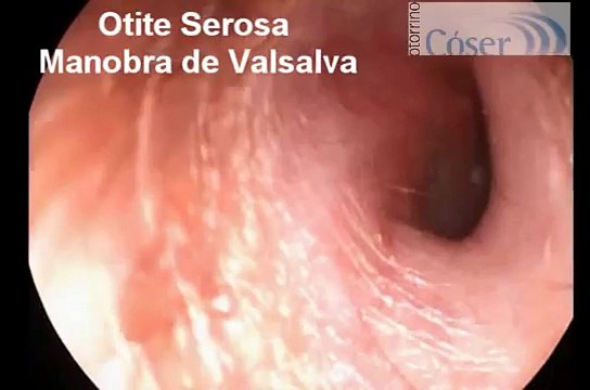 Otite Média Serosa- Videotosocopia com Manobra de Valsalva\ Otoendoscopy in Serous Otitis Media