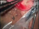 A 19 cm long worm removed from eye