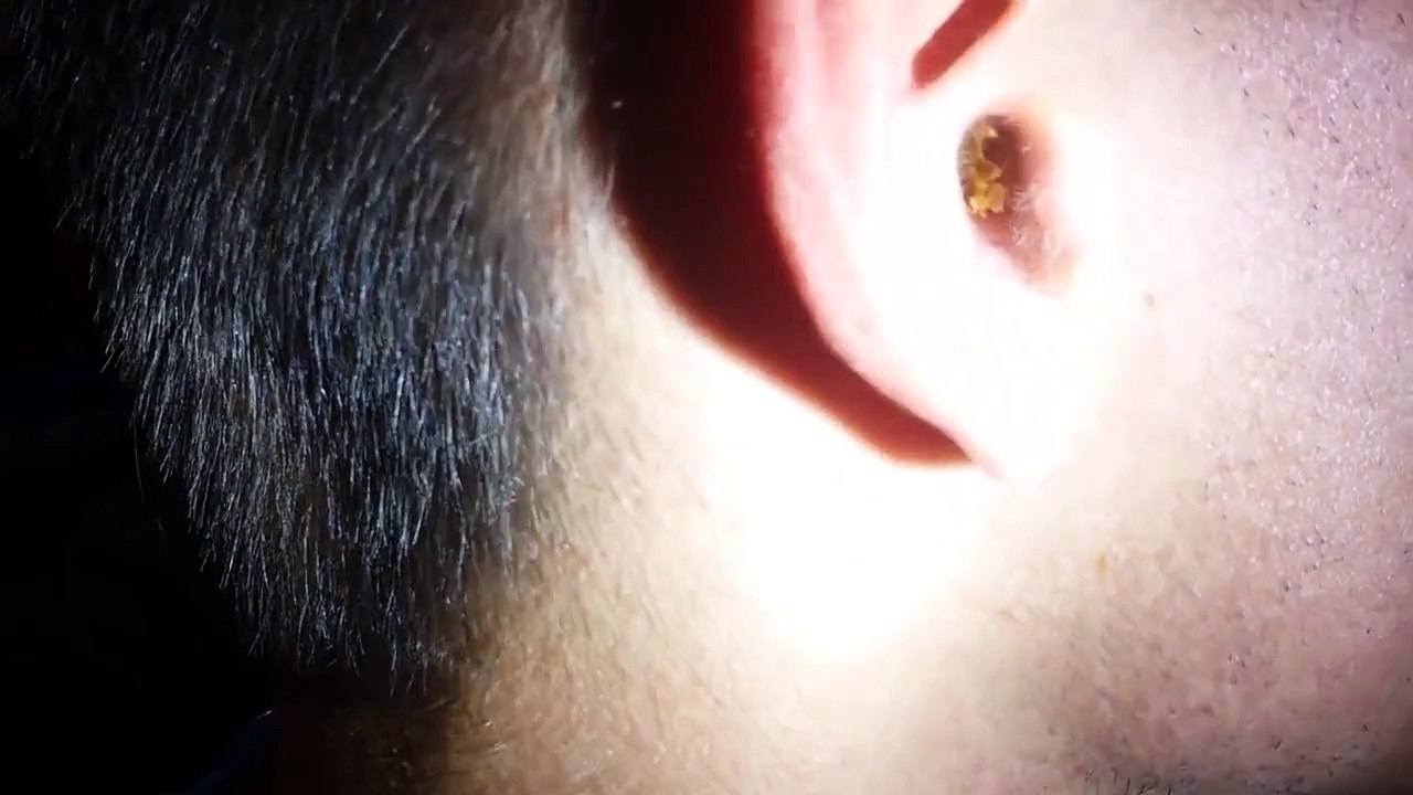 Remove earwax in the ear