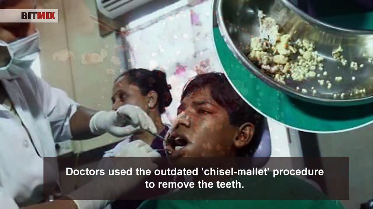 232 Teeth Removed from 'World Record' Surgery | Ashik Gavai