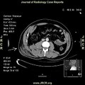 Radiology video: Lateral abdominal wall hernia following blunt trauma - a rare case