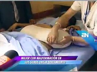 Julia María Manihuari padece de una crecimiento anormal de los senos