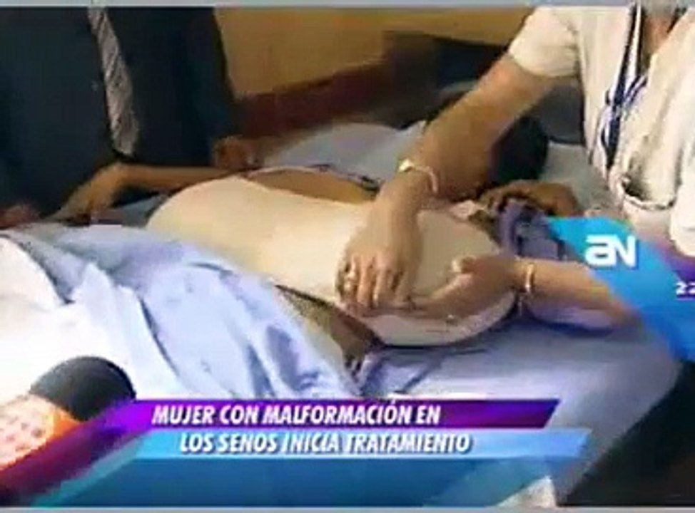 Julia María Manihuari padece de una crecimiento anormal de los senos