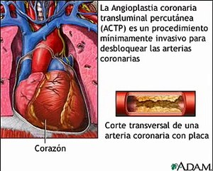 Angioplastia coronaria transluminal percutánea (ACTP)
