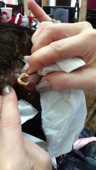Huge Sebaceous Cyst on Head Popped and Drained by Hairstylist