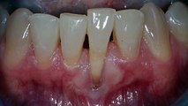 Gum Recession Surgical Treatment