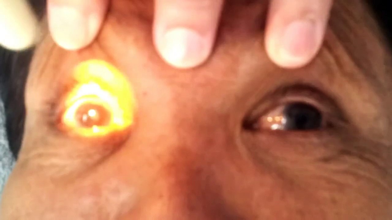 marcus gunn pupil