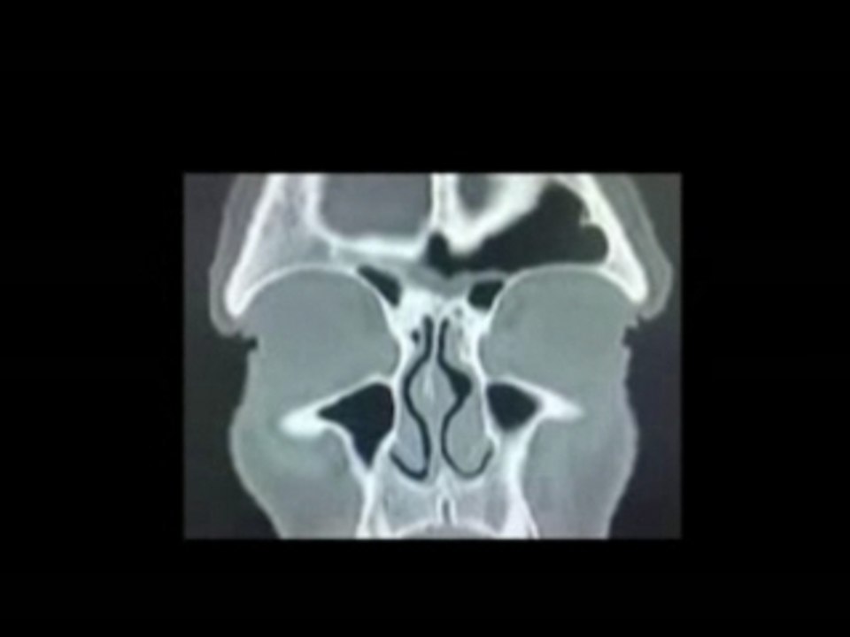 sinus