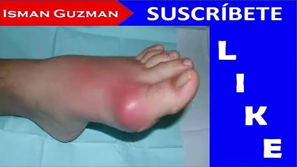 Remedios caseros para el ácido úrico