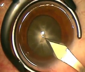 Phaco of 'russian' rock hard nearly black cataract in high myopic eye