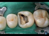 Root Canal Treatment of a Curved Upper Molar with Operating Microscope