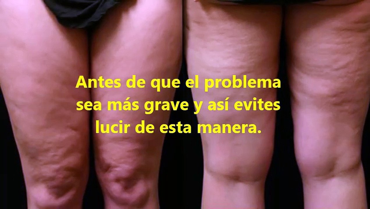 Como eliminar la celulitis rápido, tratamientos anticeluliticos