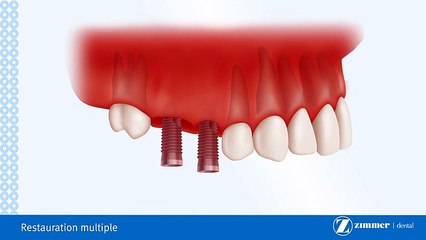 Pont Sur Implants Dentaires-Brossard-La Prairie-St-Hubert-Longueuil-Candiac...(450) 923-7999