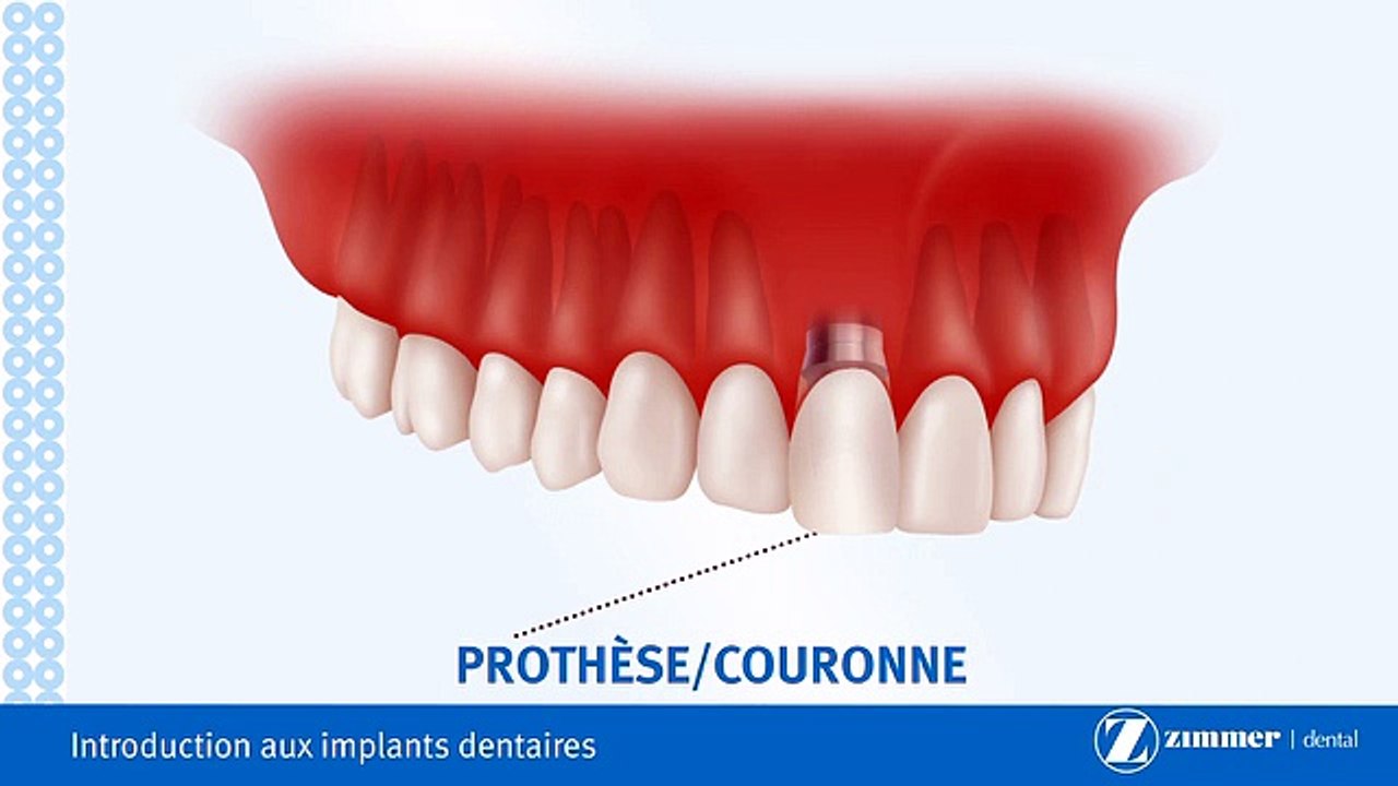 Introduction Aux Implants Dentaires-Brossard-La Prairie-St-Hubert-Longueuil-Candiac...(450) 923-7999