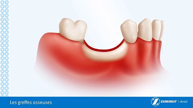 Les Greffes Osseuses-Brossard-La Prairie-St-Hubert-Longueuil-Candiac...(450) 923-7999