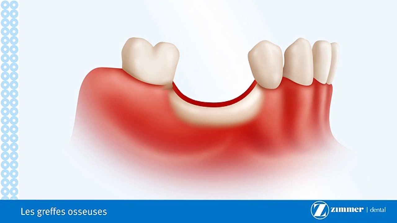 Les Greffes Osseuses-Brossard-La Prairie-St-Hubert-Longueuil-Candiac...(450) 923-7999