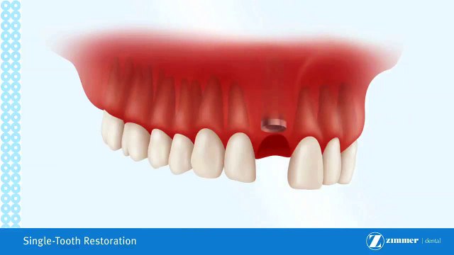 Crown On Implant Brossard-La Prairie-St-Hubert-Longueuil-Candiac...(450) 923-7999