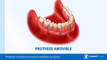 Prothèse Complète Amovible Sur Barre-Brossard-La Prairie-St-Hubert-Longueuil-Candiac...(450) 923-7999