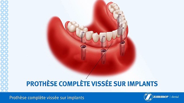 Prothèse Complète Fixe Sur Implants-Brossard-La Prairie-St-Hubert-Longueuil-Candiac...(450) 923-7999