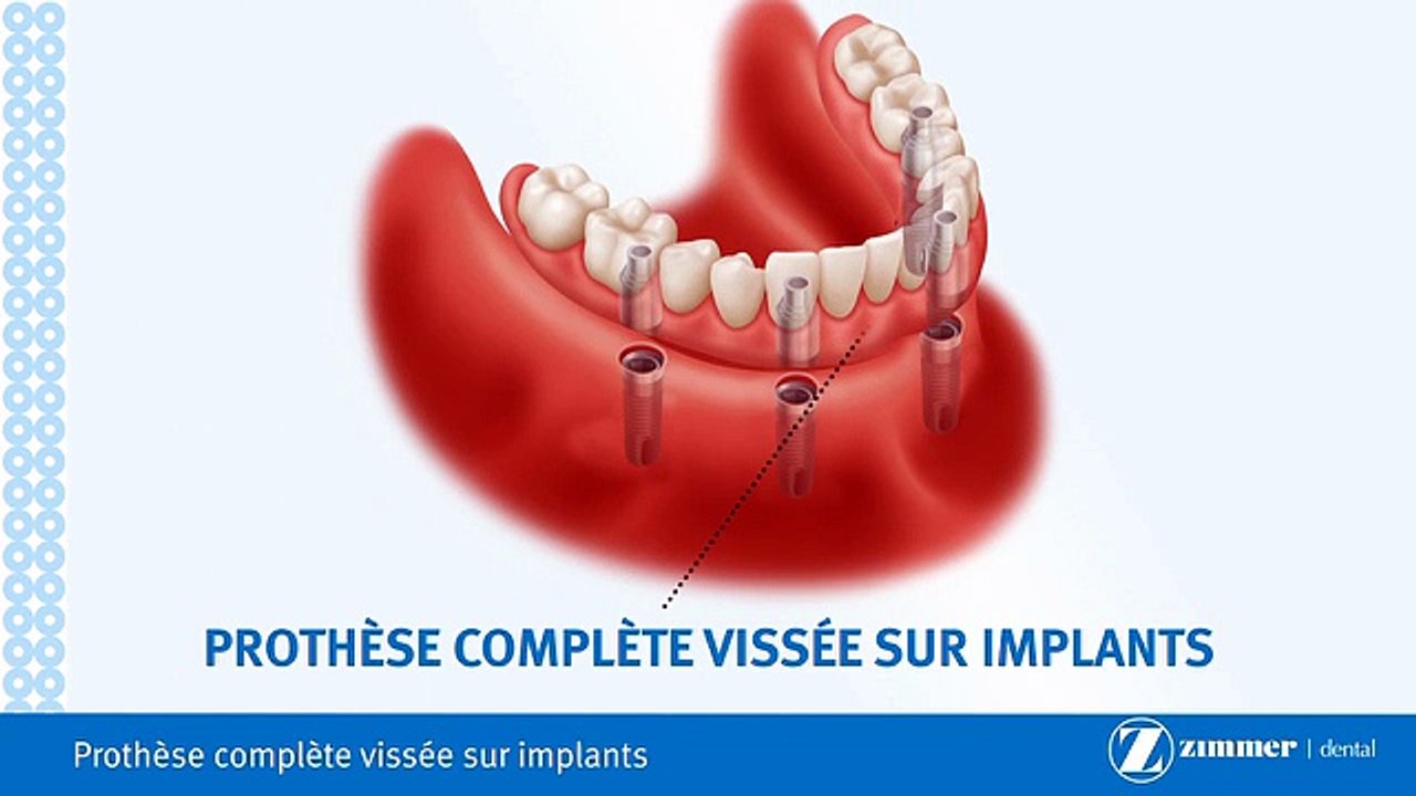 Prothèse Complète Fixe Sur Implants-Brossard-La Prairie-St-Hubert-Longueuil-Candiac...(450) 923-7999