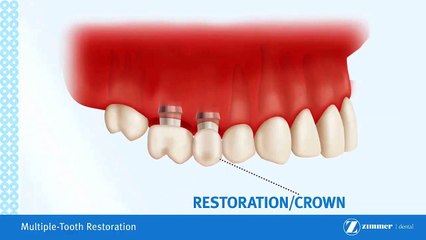 Bridge On Implants Brossard-La Prairie-St-Hubert-Longueuil-Candiac...(450) 923-7999