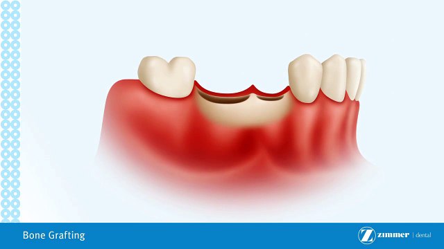 Dental Bone Grafting Brossard-La Prairie-St-Hubert-Longueuil-Candiac...(450) 923-7999