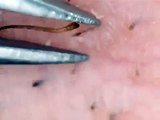 sticky Ingrown hairs refuses to be extracted