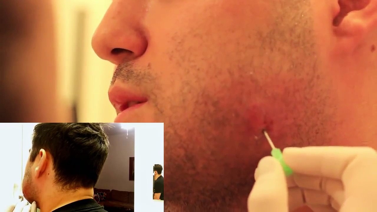 Lancing Abscess on My Face