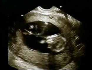 УЗИ плода 19 недель